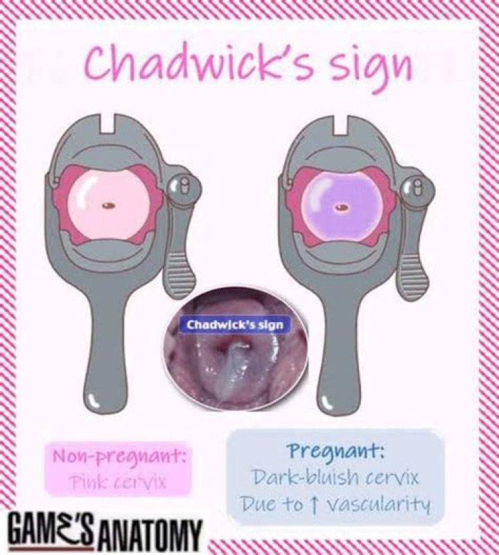 Chadwick Sign What Is It, Causes, and More Osmosis