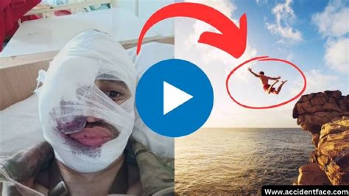 Face Split Diving Accident Twitter Video: How Did It Happen? Boy face split while Diving