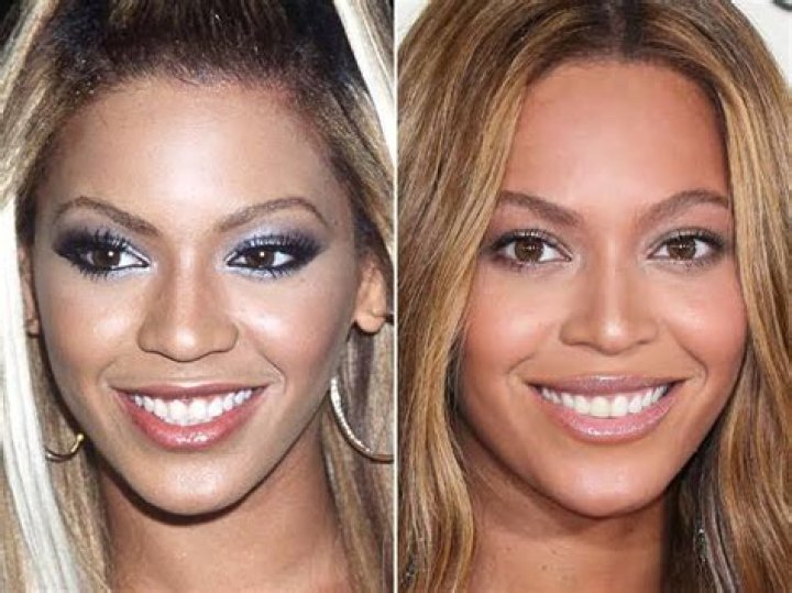 Has Beyonce had Plastic Surgery? Why Did Beyonce Get Foot Surgery?