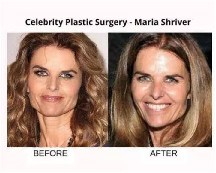 Has Maria Shriver Had Plastic Surgery? Truth Revealed Here!