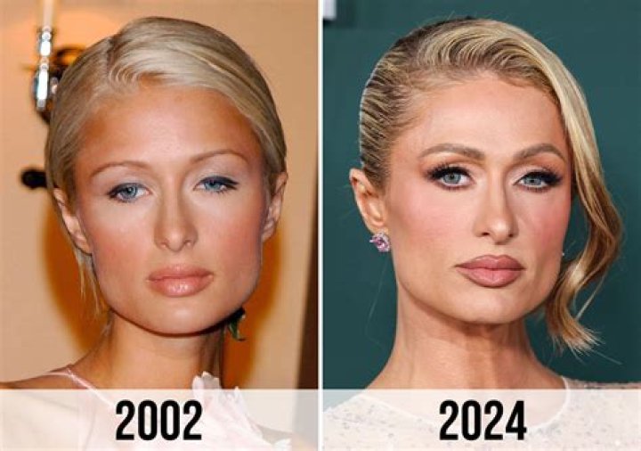 Has Paris Hilton had Plastic Surgery? Get Details Here