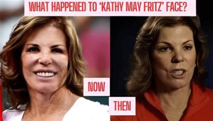 Kathy May Fritz face Surgery What's the deal with her face Surgery? SoapAsk